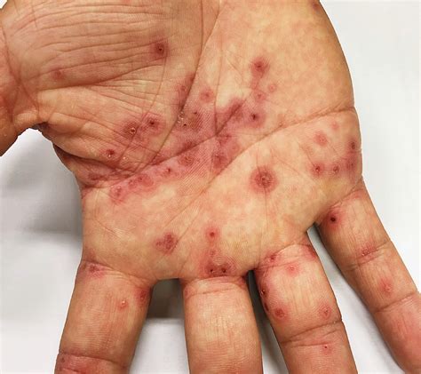 Herpes virus on hands