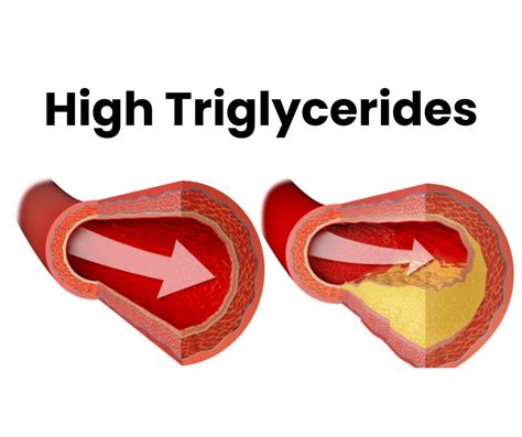 High Triglycerides