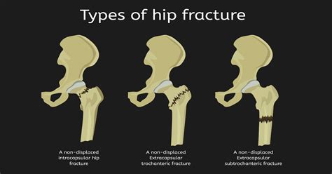 Hip Fracture Surgery