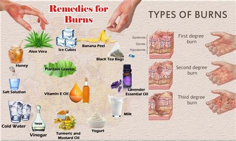 home remedies for 2nd degree burns