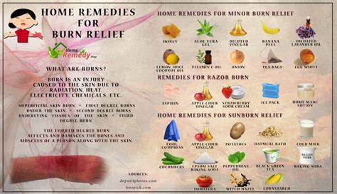 home remedies for burn relief