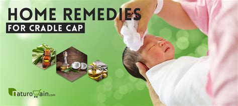 Home Remedies for Cradle Cap
