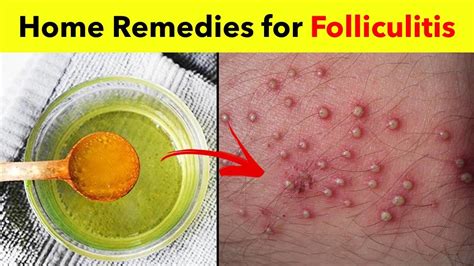 home remedies for folliculitis