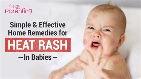 home remedies for heat rash in babies