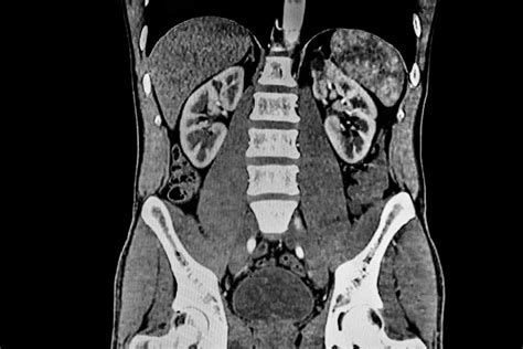 How Abdominal CT Scan Works