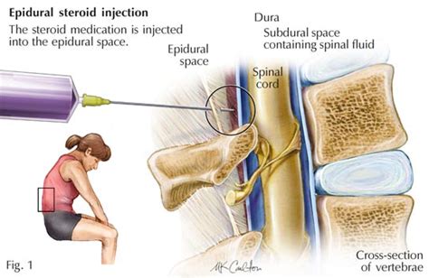 How Epidural Injections Work