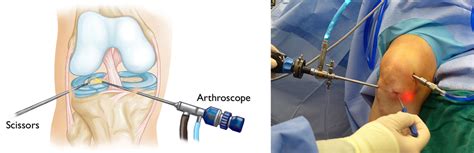 How is Meniscus Tear Surgery Performed
