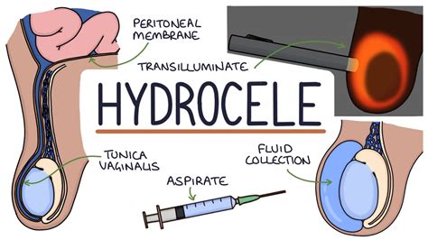 hydrocele