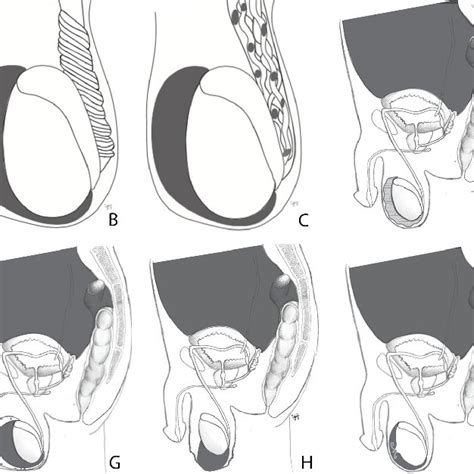 hydrocele conclusion