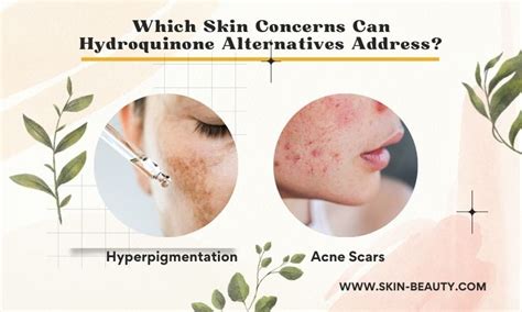 Hydroquinone Alternatives