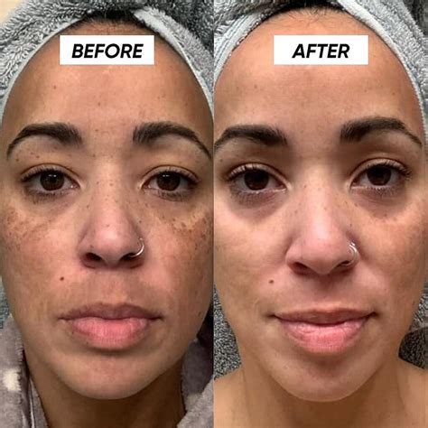 hyperpigmentation