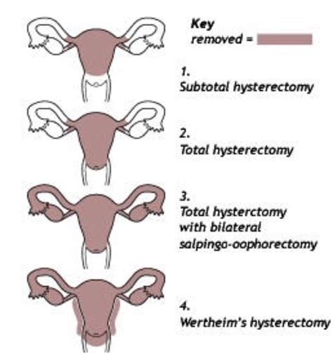 hysterectomy benefits
