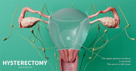 Hysterectomy Surgery