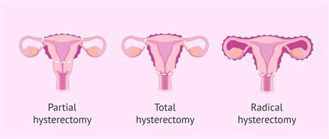 hysterectomy types