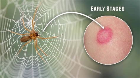 identifying brown recluse spider bites