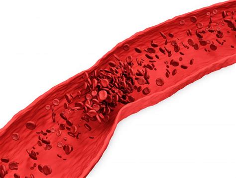 Increased Blood Viscosity