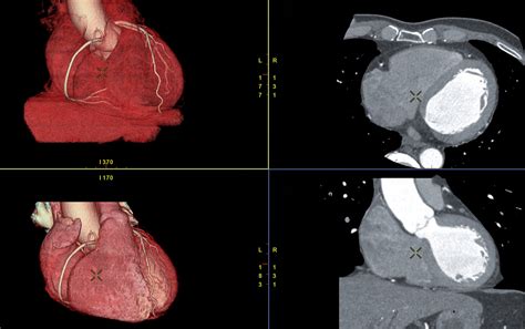 Indication for Coronary CT Scan