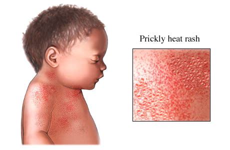 infant prickly heat conclusion