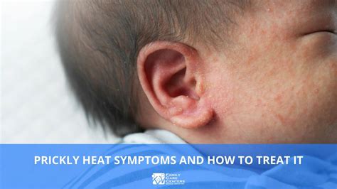 infant prickly heat treatment