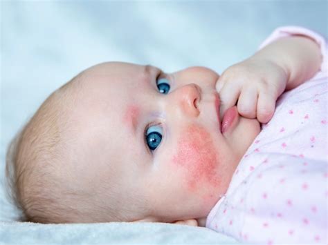 infant rash conclusion