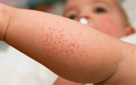 infant rash medical attention