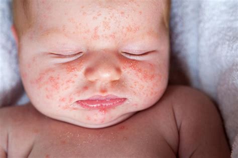 infant rash on face