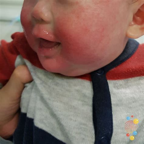 infant viral rash causes