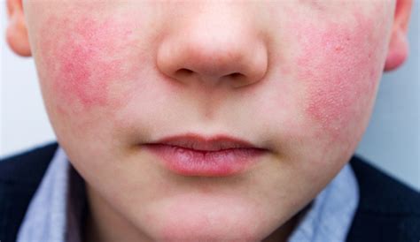 infant viral rash complications