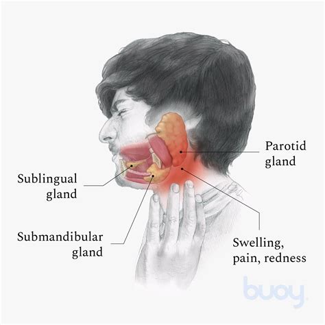 inflamed salivary gland symptoms