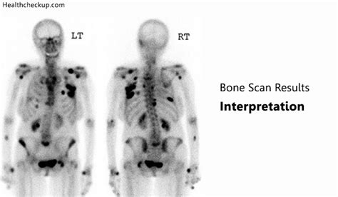 interpreting bone scan results