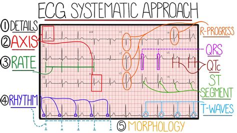 interpreting electrocardiogram results