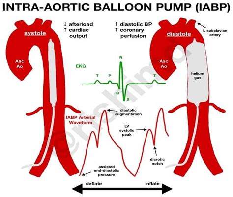 Intra Aortic Balloon Pump Mechanism