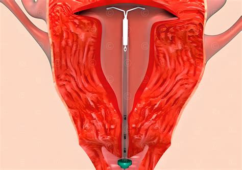 Intrauterine Devices (IUDs)