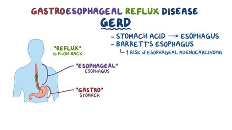 Introduction to Acid Reflux Management