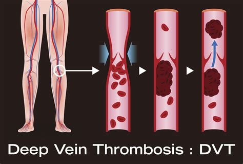 Introduction to Leg Vein Thrombosis