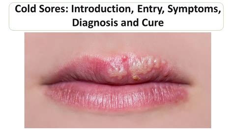 Introduction to Cold Sores