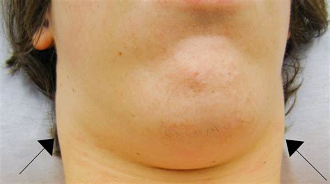 Jaw Lymph Nodes Swelling