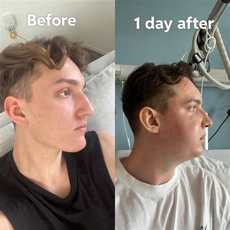 Jawline complications and risks