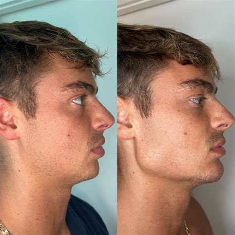 Jawline conclusion and next steps