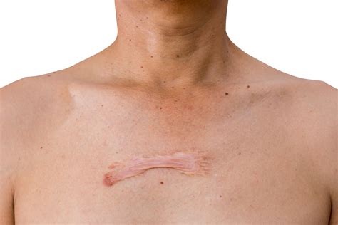 keloid conclusion