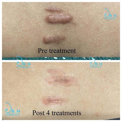 Keloid scar removal options
