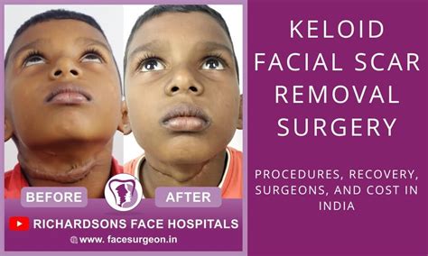 Keloid scar removal cost