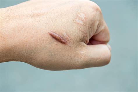 Keloid scar removal risks and complications