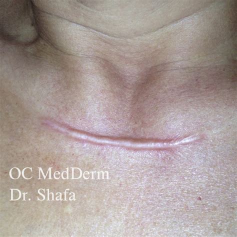 keloid treatment