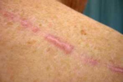 keloids causes