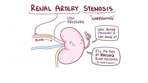 Kidney Artery Stenosis Causes