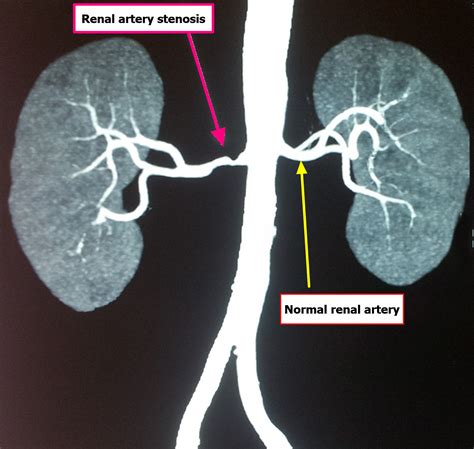 Kidney Artery Stenosis Conclusion