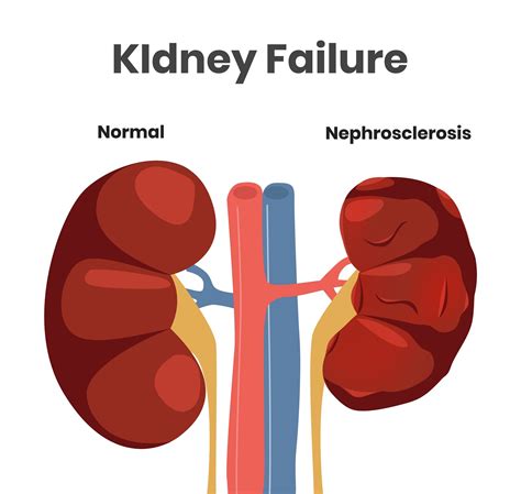 Kidney Damage