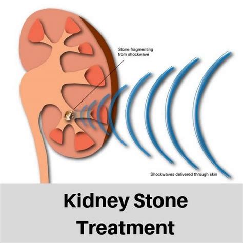 Kidney Stones
