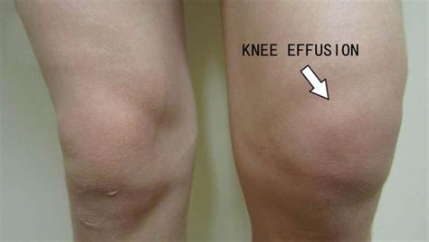 knee effusion complications